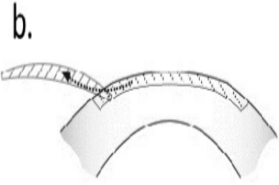 全飞秒手术示意图