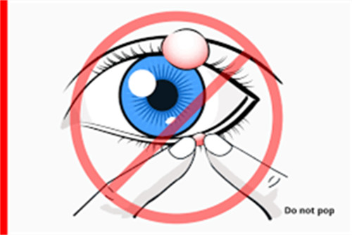 麦粒肿注意示意图
