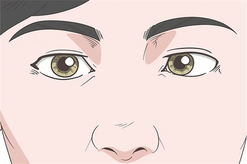 内斜视示意图 内斜视示意图