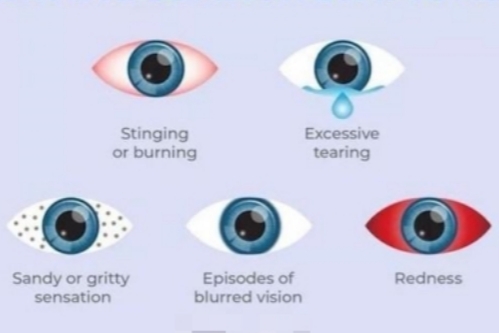 干眼症症状表现示意图 干眼症症状表现示意图