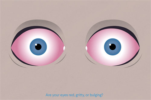 甲亢病人眼睛为何越来越凸？神秘的突变引发的真相揭秘！