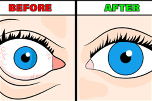 眼凸与正常对比示意图 眼凸与正常对比示意图