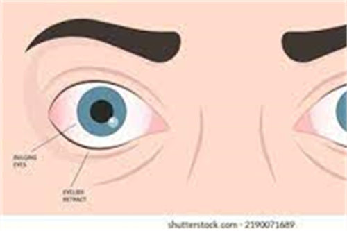 眼凸示意图 眼凸示意图