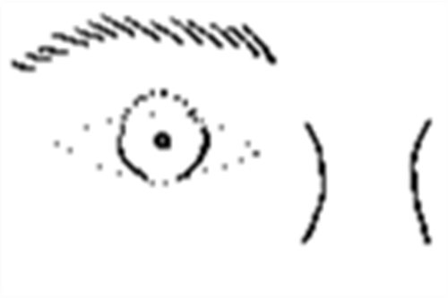 眼凸示意图 眼凸示意图