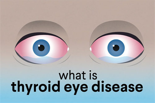 眼凸示意图 眼凸示意图