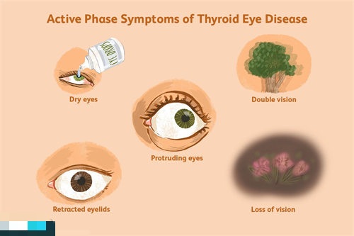 眼凸示意图 眼凸示意图