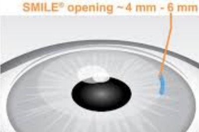 揭秘近视眼睛手术价钱：视力重生的价钱是多少？