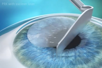 LASEK手术