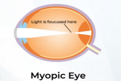 揭秘：近视眼球外凸怎么恢复，全飞秒可以治疗眼睛突出吗？