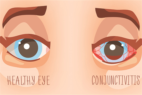 结膜炎示意图