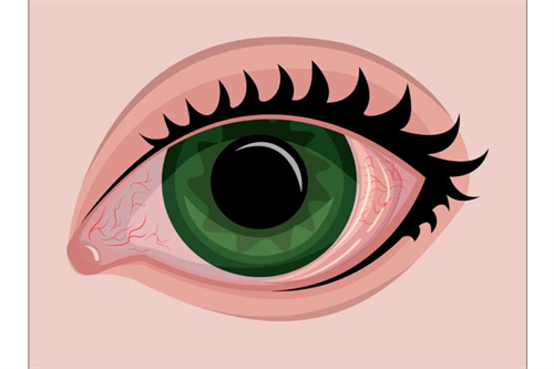 告诉你结膜炎的症状和原因，记得保护眼睛从我做起！