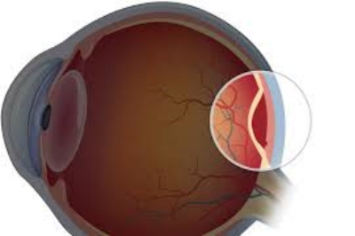 视网膜脱落