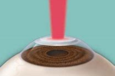 准分子激光手术费用揭秘：让你知道准分子激光多少钱！