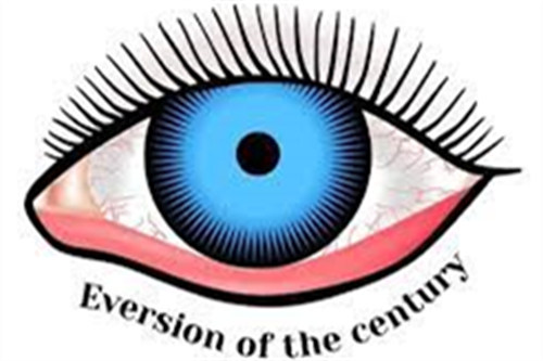 眼睑下翻示意图