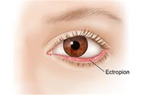 眼睑下翻示意图