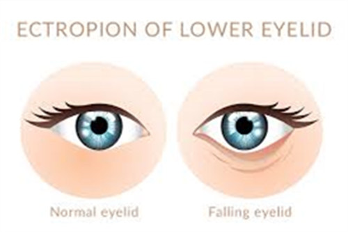 眼睑下翻示意图