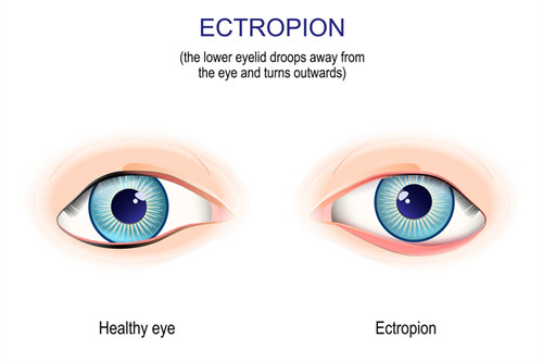 眼睑下翻示意图