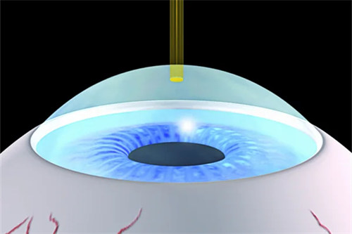 smart全激光示意图