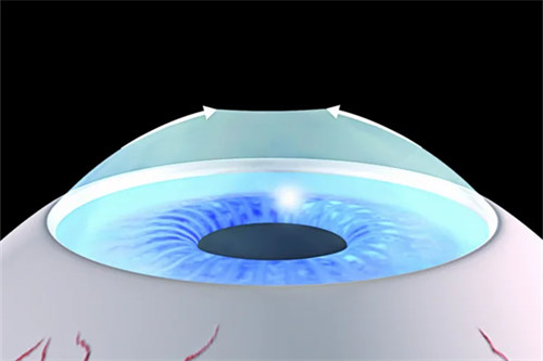 smart全激光示意图