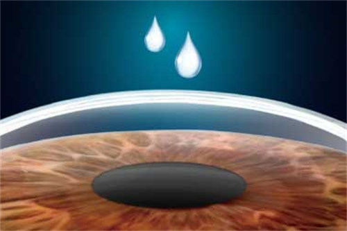 smart全激光手术示意图