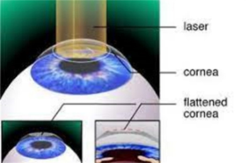 SMART全激光近视手术