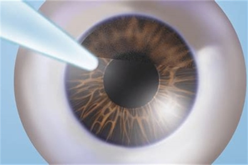 Smart全激光手术