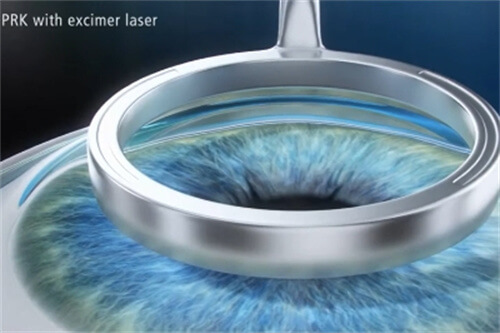 LASEK手术
