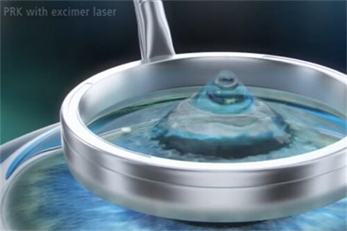 深圳近视眼手术价格：华厦/安洲/黑马/悦瞳近视眼手术价格都有！