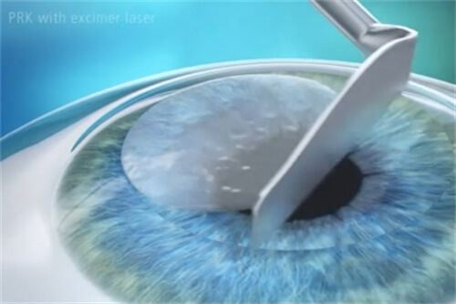 准分子激光手术过程