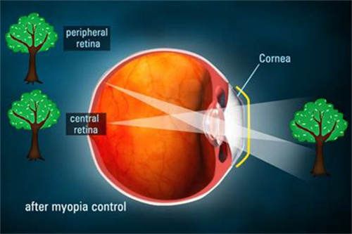 远视之谜揭秘：探寻远视的原因及致病因素