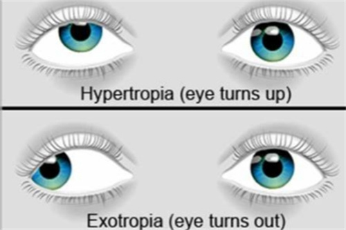 外斜视 外斜视