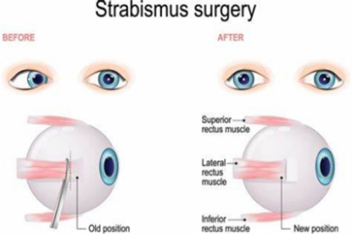 斜视眼球状况 斜视眼球状况