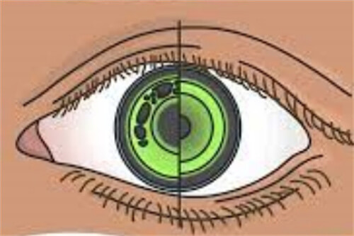 角膜塑形镜示意图