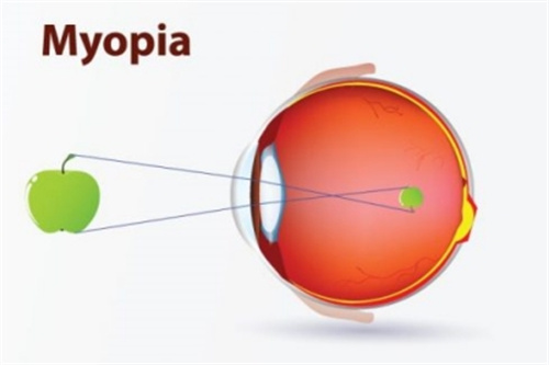 几度才算近视？50-300度是轻度近视、325-600是中度近视、600度以上是高度近视！