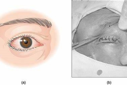 倒睫手术示意图