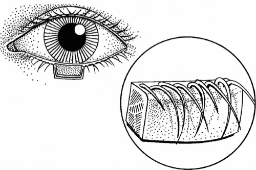 倒睫手术示意图