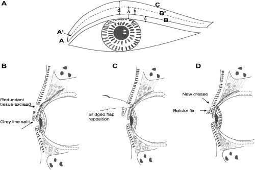 干货：倒睫手术要多少钱？还有倒睫手术的原理及注意事项！