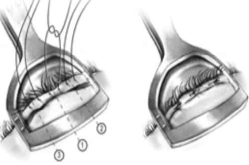 倒睫手术示意图