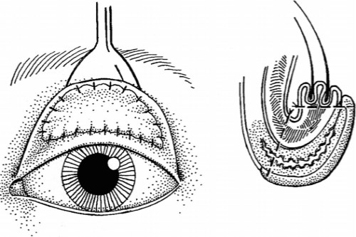 倒睫手术示意图