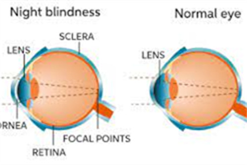 夜盲症眼睛与正常眼睛对比示意图 夜盲症眼睛与正常眼睛对比示意图