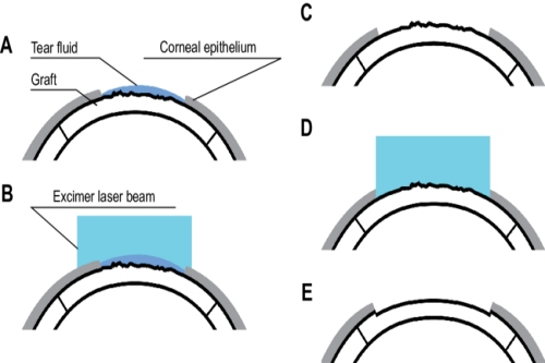 SMART手术过程 SMART手术过程