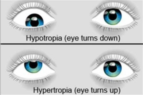 上下斜视 上下斜视