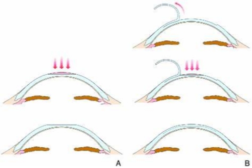 Smart全激光手术