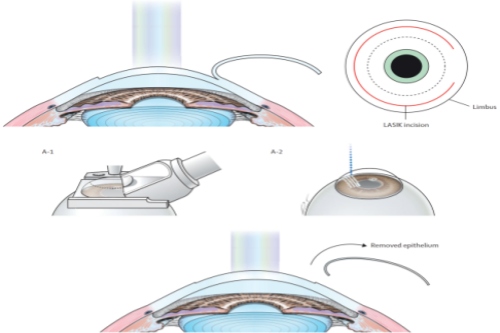 Smart全激光手术
