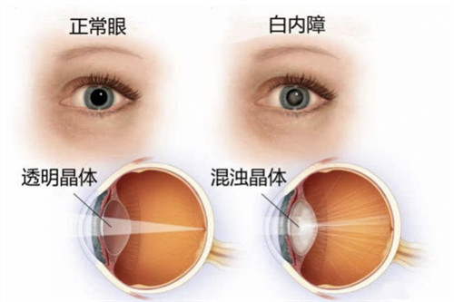 正常眼和白内障晶体对比示意图