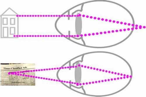 正常眼与远视眼对比