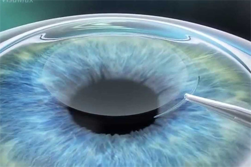 为什么大多数近视人群都倾向于全飞秒手术？它有哪些优势？