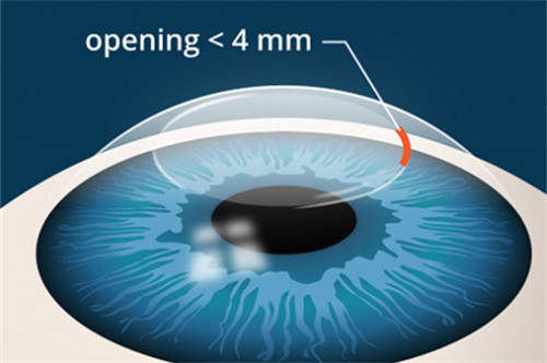 全飞秒手术示意图 全飞秒手术示意图