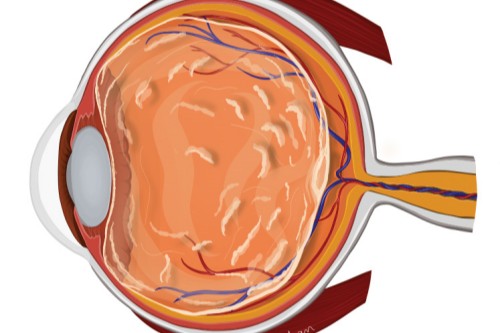 玻璃体浑浊动画示意图
