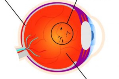 玻璃体浑浊动画示意图